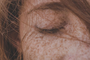 Bleichcreme: Pigmentflecken loswerden in kurzer Zeit