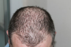 Haarwachstum Serum